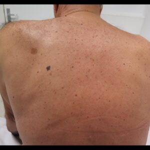 Melanoma on the back of a patient with photodamage