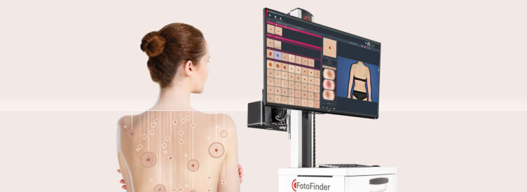 Seguimiento digital nevus, fotofinder