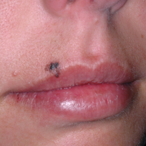 Melanoma on the upper lip in a young patient