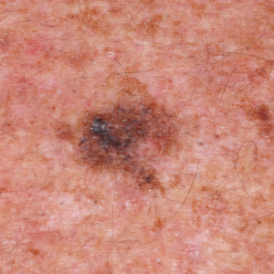 Melanoma developing on photodamaged skin