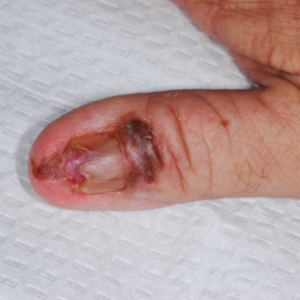 Invasive melanoma on a patient's thumbnail