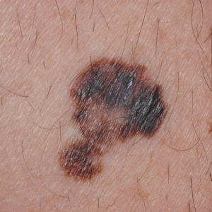 Melanoma showing all ABCDE criteria