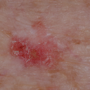 Detalle de un carcinoma escamoso cutáneo