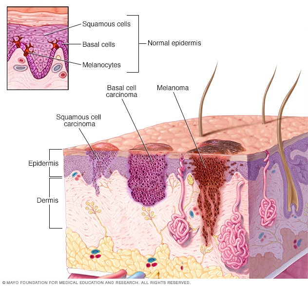 Diagrama que muestra histológicamente los diferentes tipos de cáncer de piel