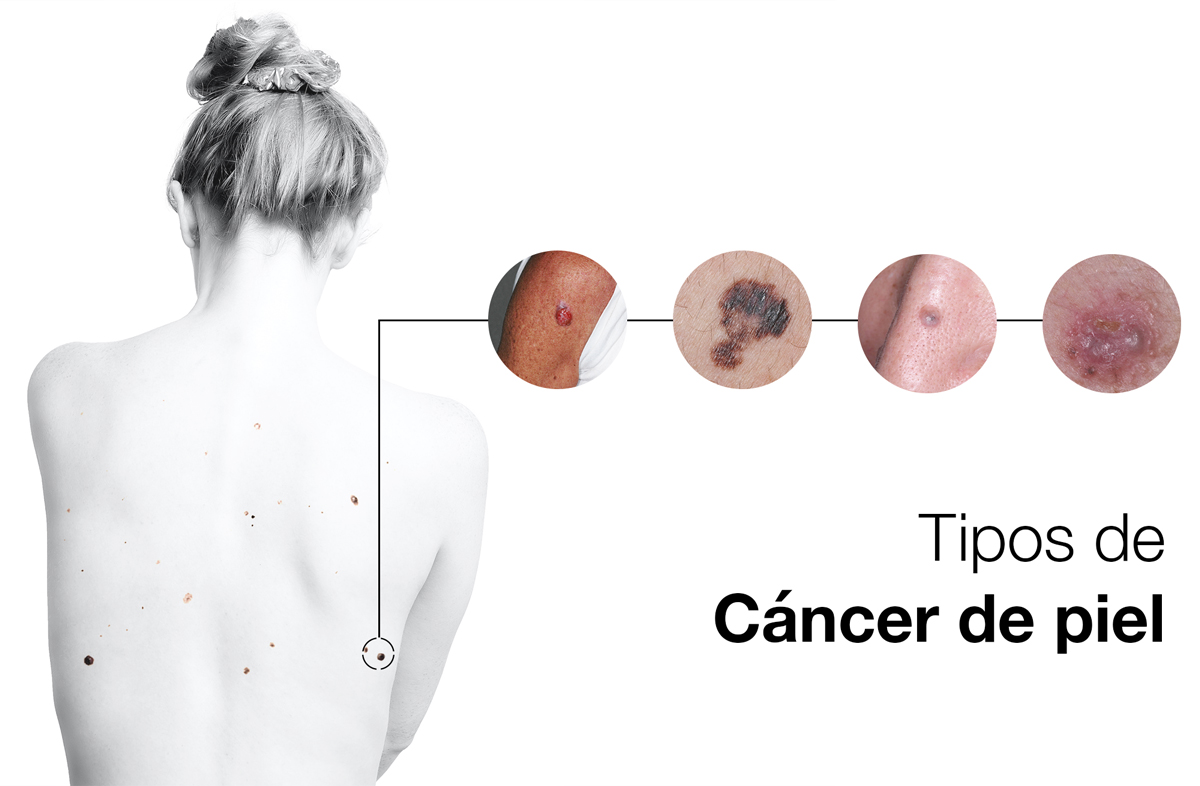 Diagrama que muestra los diferentes tipos de cáncer de piel