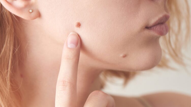 Mole removal on the face