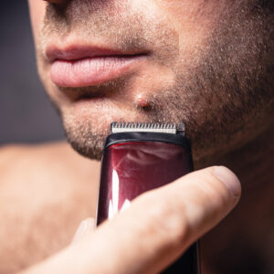 Dermal nevus on the chin of a man irritated by shaving