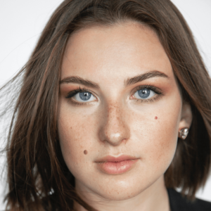 Dermal nevus on the face of a young woman