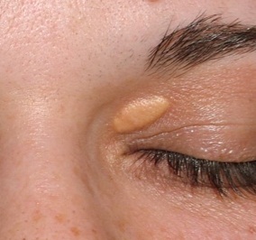 Xanthelasma on the eyelid of a young woman