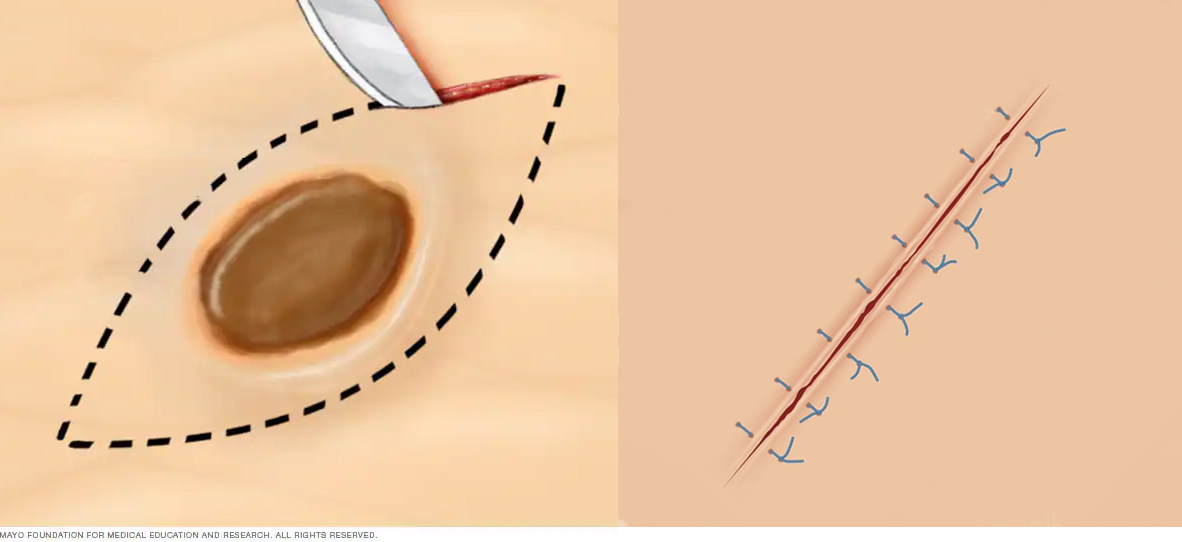 illustration showing how to perform an excisional biopsy to remove a mole from the skin