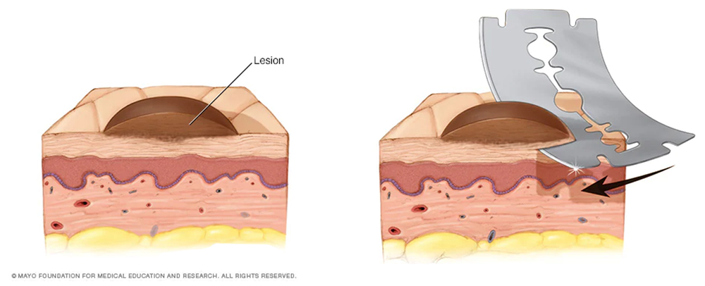illustration showing how to remove a raised mole or dermal nevus by shaving technique