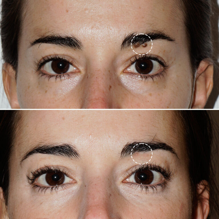 Dermatological photo showing before and after removal of a mole on the eyebrow.