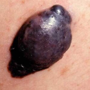 Fast-growing nodular melanoma manifesting as a black wart