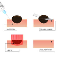 Diagrama que muestra cómo quitar un lunar con láser