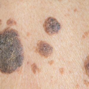 Laser removal of seborrheic keratoses
