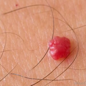 Angioma or ruby spot removal