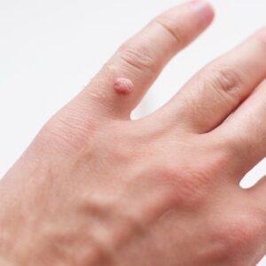 Verruga vírica en los dedos de la manos de un paciente