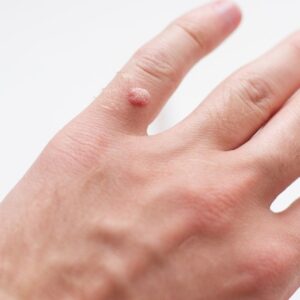 Viral wart on a patient's fingers