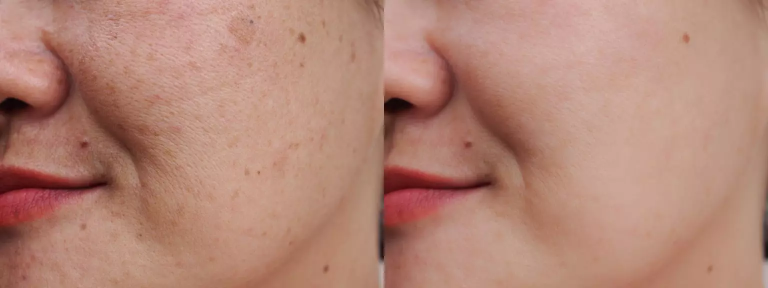 Antes y después del tratamiento láser de manchas en la cara con luz pulsada intensa en una mujer jóven