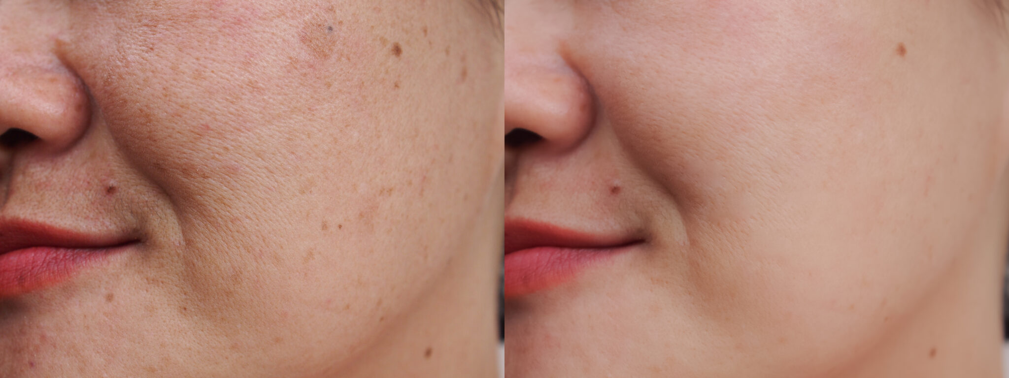 Clínicas para Quitar Manchas de la Cara: ¿Cuál Elegir?