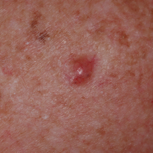Close-up of a basal cell carcinoma