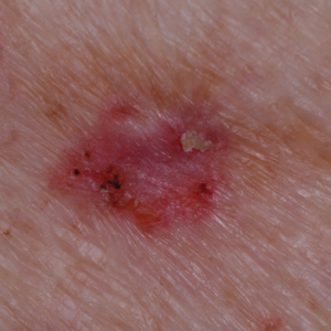 Detail of a basal cell carcinoma, a type of skin cancer.