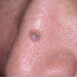 Carcinoma basocelular en el dorso de la nariz de un paciente