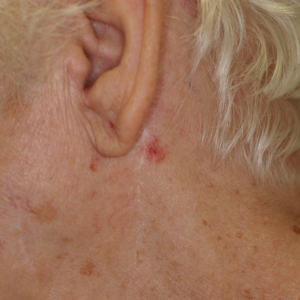 Carcinoma basocelular en la región retroauricular de una mujer mayor