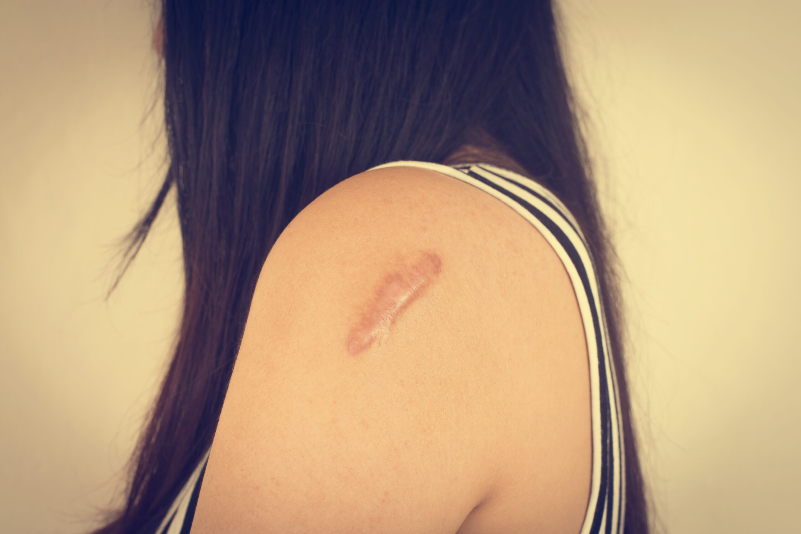 Gran queloide en el brazo de una paciente después de haber quitado un lunar