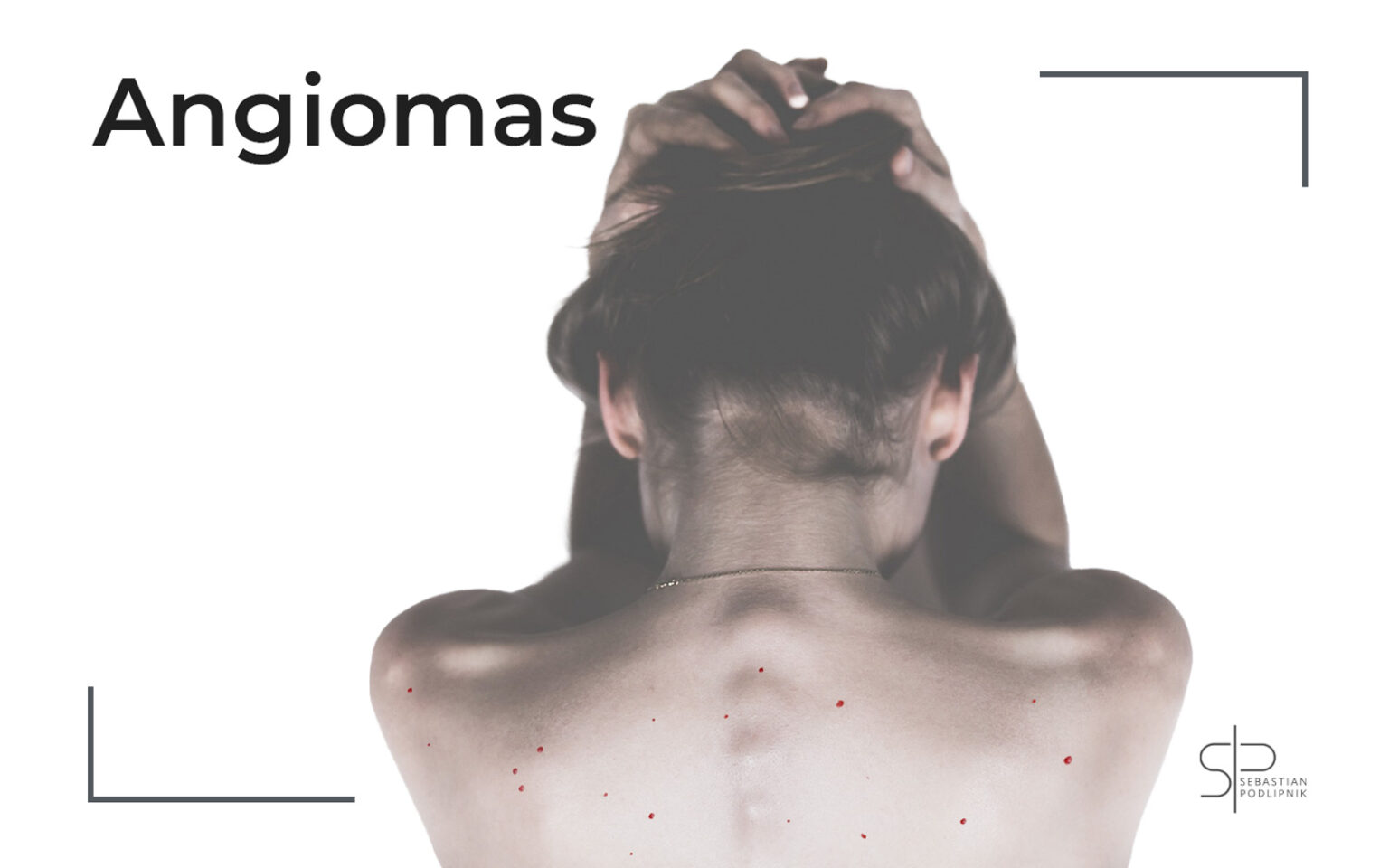 Paciente de dermatología que presenta lunares rojos o puntos rojos en la piel de la espalda