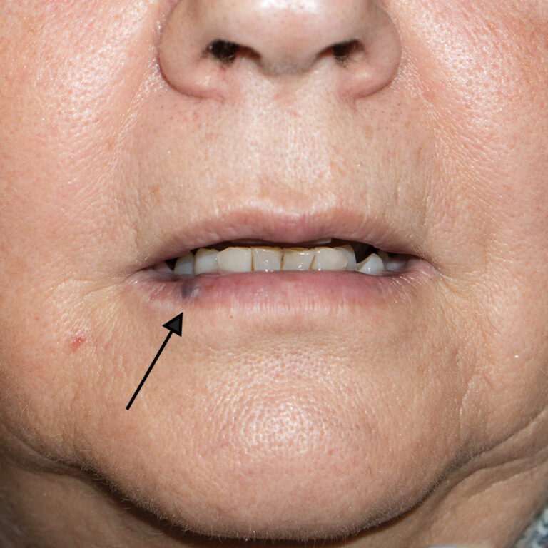 Elderly patient presenting with a vascular lacuna in the lower lip.