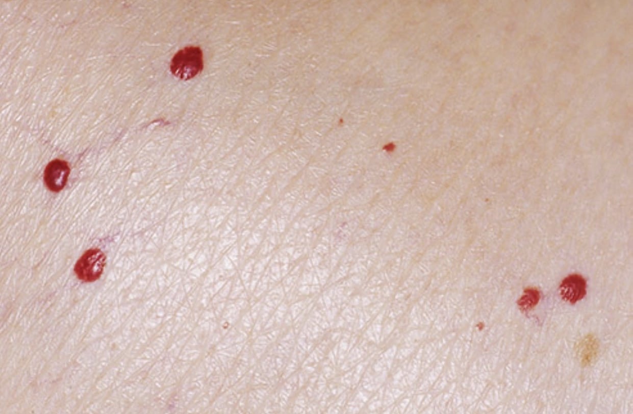Detalle de lunares rojos o puntos rojos en la piel de un paciente mayor con fotodaño