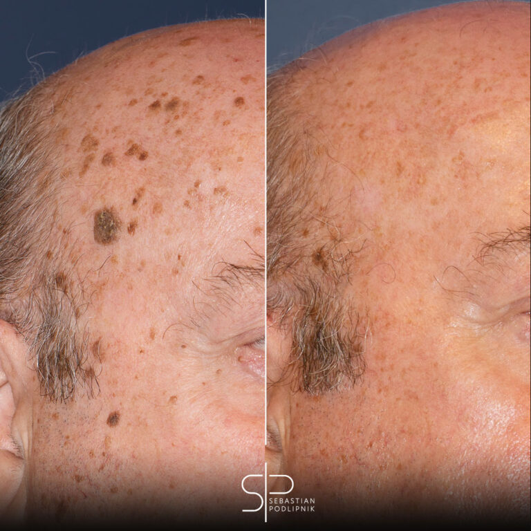 Lunar con costra o queratosis seborreicas ¿Qué es y cómo eliminarlos?