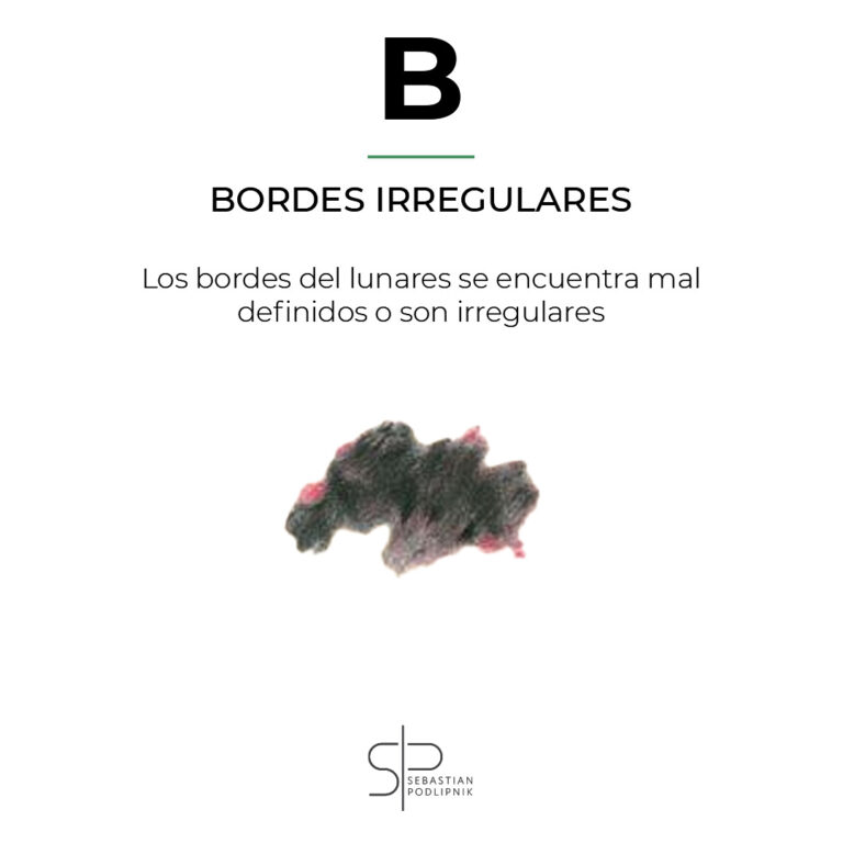ABCDE rule showing irregular borders in a suspicious malignant mole