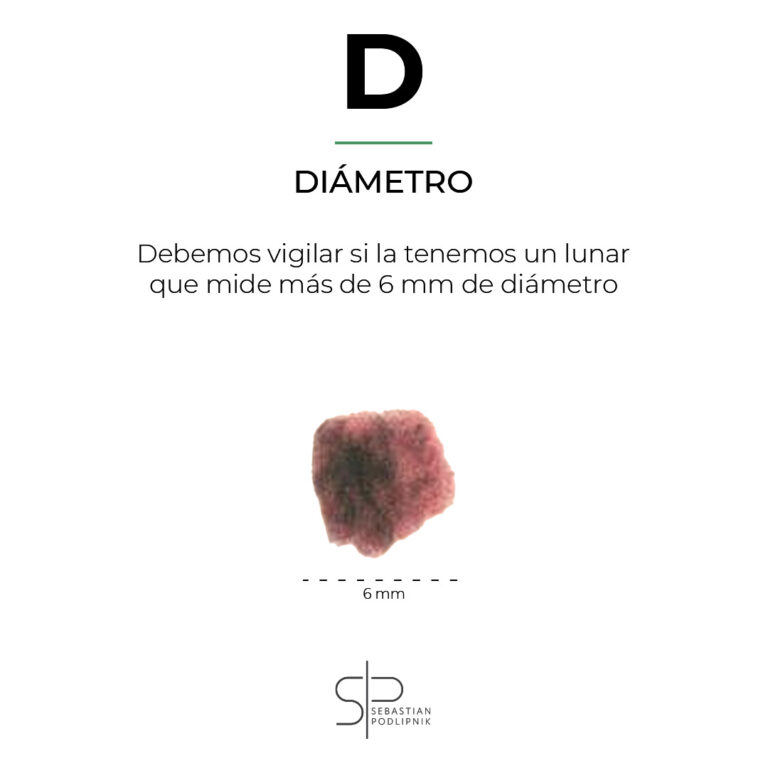 ABCDE rule showing a diameter greater than 5 mm in a suspicious cancerous mole.