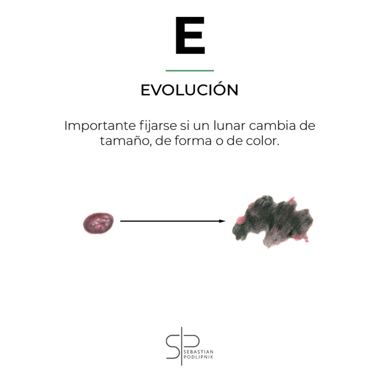 ABCDE rule of melanoma showing the E of evolution of a malignant mole.