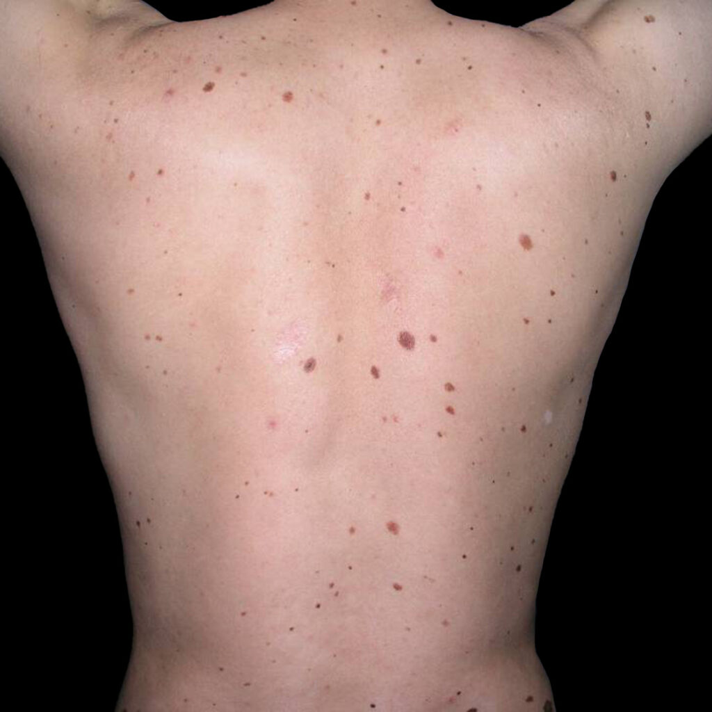 Back of a patient with dysplastic nevus syndrome with many new moles.