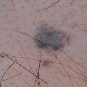 Dermatoscopia de un nevus azul