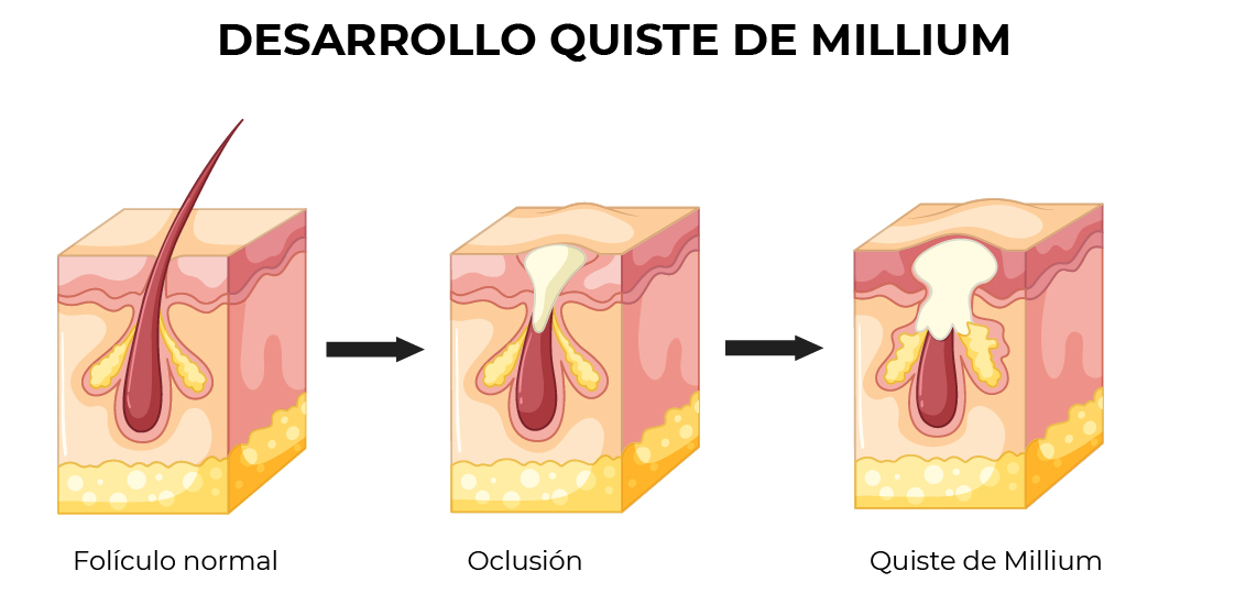 Ilustración que muestra el desarrollo de quistes de millium