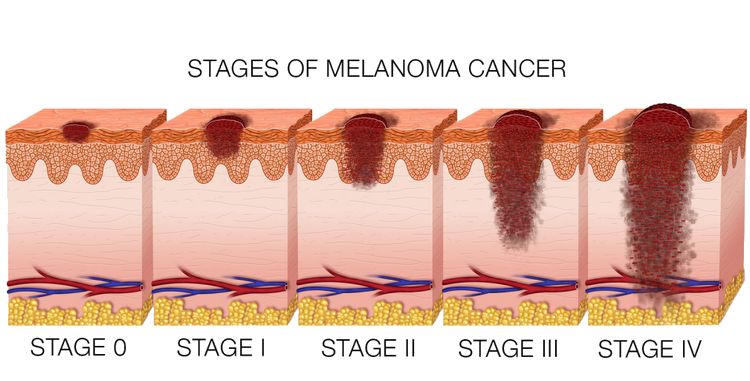 Melanoma Skin Cancer Stages
