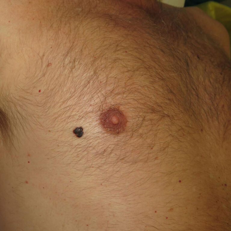 Lunar maligno o melanoma en el pecho de un paciente