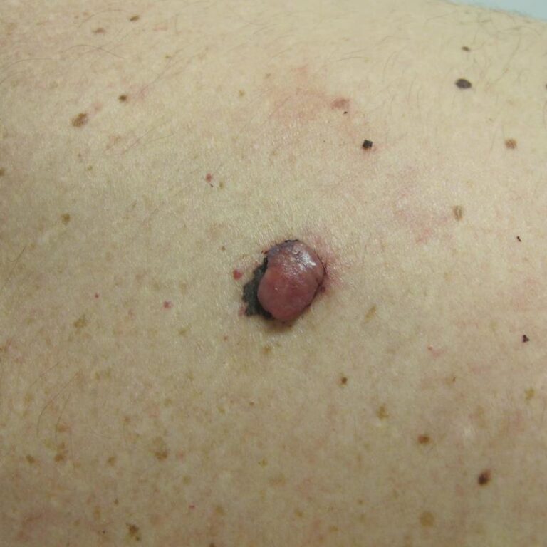 Amelanotic melanoma or malignant unpigmented moles growing on a patient's back