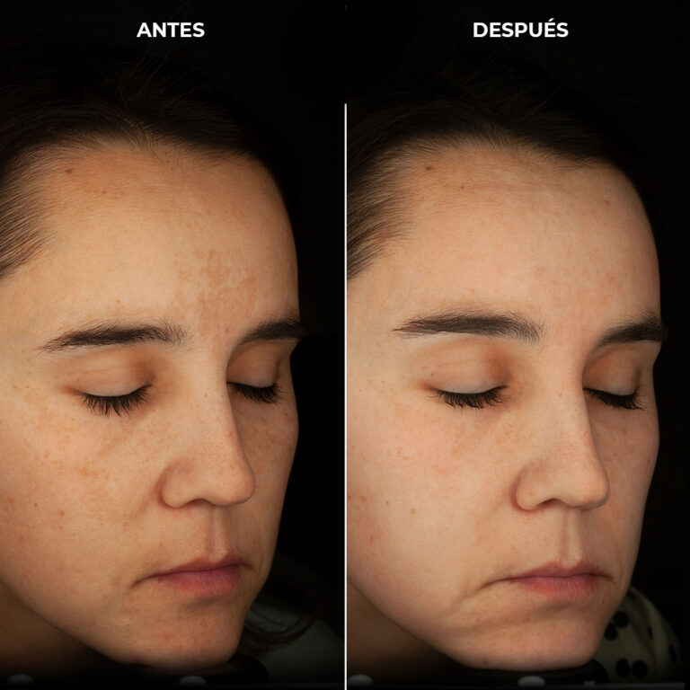 Mild melasma or facial blemishes in treatment with creams