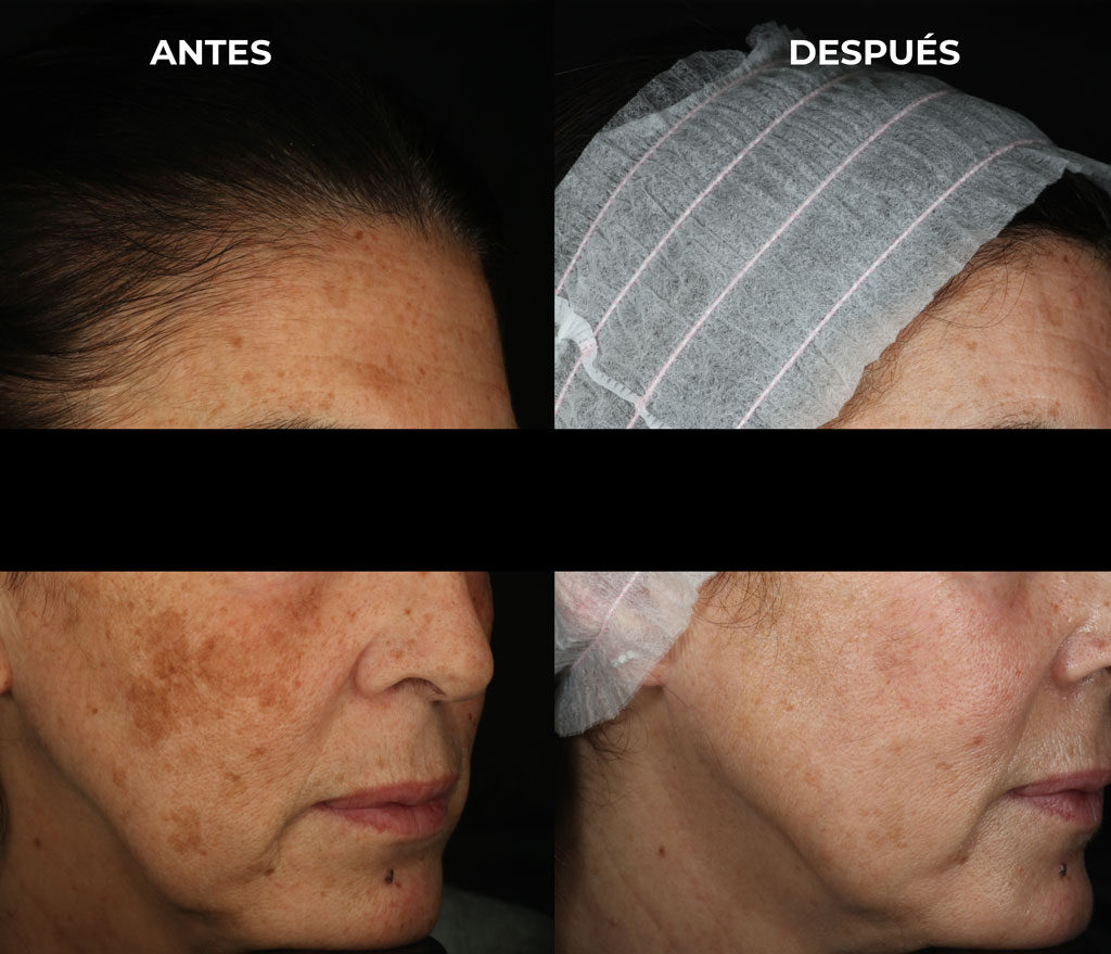 Manchas faciales con léntigos más melasma facial en una paciente mostrando un antes y depsués
