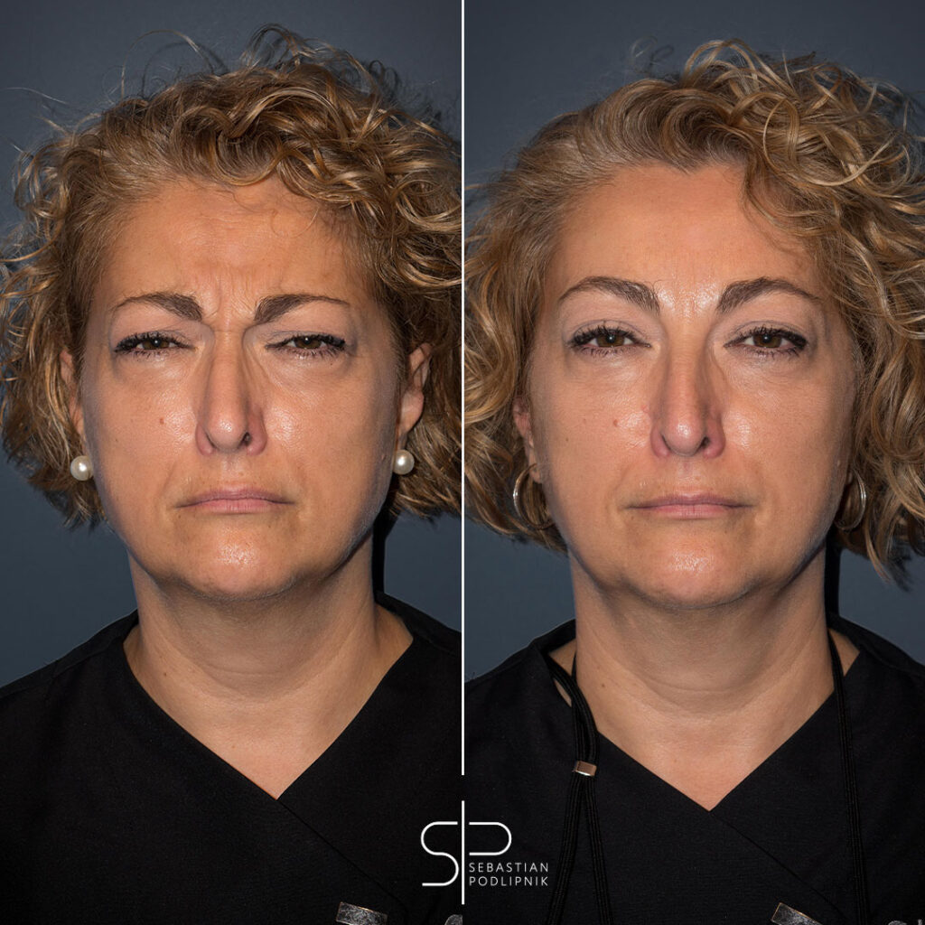 Botox before and after patient with wrinkles between the eyebrows