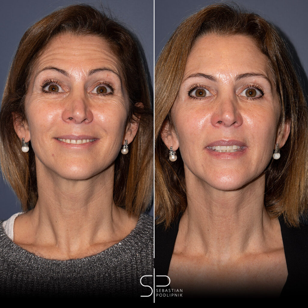 Botox antes y después de un paciente con arrugas en la frente