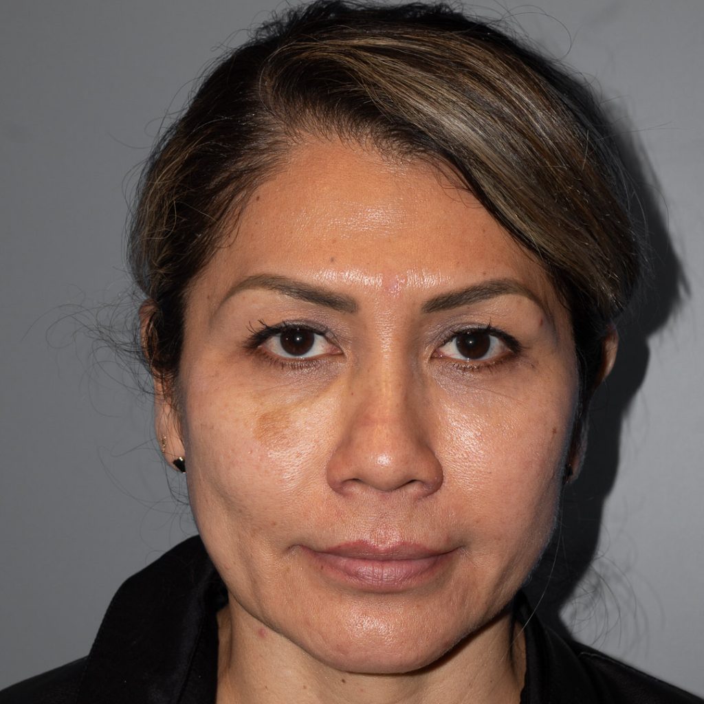 Patient seeking removal of sunspots on the face, also known as sun lentigines.