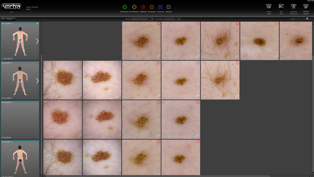 monitoring with digital dermatoscopy or epiluminescence microscopy with dermagraphics