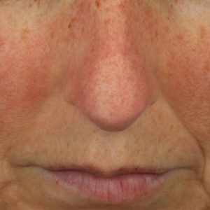 Facial blemishes caused by sun exposure. Before the procedure