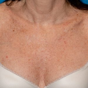cleavage of a patient with many sunspots or sun lentigines